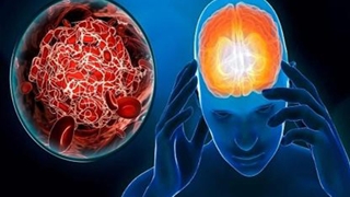 Thời tiết bất thường có làm tăng nguy cơ đột quỵ?